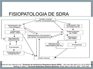 Matthay, A. Ware, L. The Acute Respiratory Distress Syndrome. NEJM. May 4, 342 (18). 2000. 1334-1348
FISIOPATOLOGIA DE SDRA
Ponce de Leon, Manuel; et al. “Sindrome de Insuficiencia Respiatoria Aguda (SIRA)”. Rev Asoc Mex Med Crit y Ter Int 2004; 18(1
 