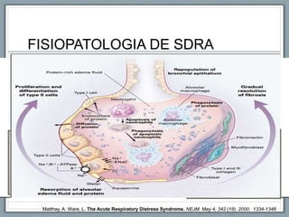 FISIOPATOLOGIA DE SDRA
Matthay, A. Ware, L. The Acute Respiratory Distress Syndrome. NEJM. May 4, 342 (18). 2000. 1334-1348
 