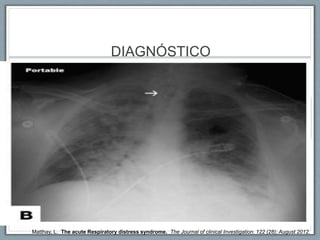 DIAGNÓSTICO
Infiltrados
Pulmonares
Bilaterales
Hipoxemia
Severa
PaO2/FiO2<200
Ausencia de
Falla ♥
Matthay, L. The acute Respiratory distress syndrome. The Journal of clinical Investigation. 122 (28); August 2012.
 