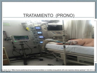 TRATAMIENTO (PRONO)
Sud, Sachin. Et al. “Effect of prone positioning during mechanical ventilation on mortality among patients with acute respiratory distress syndrome” CMAJ 2014, July
8, 2014, 186 (10).
 