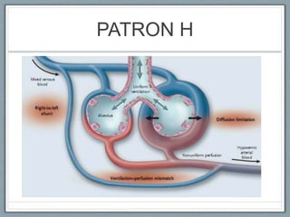 PATRON H
• ALTA ELASTANCIA.
• CORTOCIRCUITOS DE DEECHA A IZQUIERDA.
• ALTO PESO PULMONAR.
• ALTA CAPACIDAD DE RECLUTAMIENTO.
 
