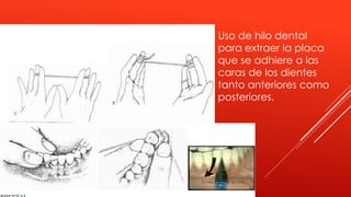 Uso de hilo dental
para extraer la placa
que se adhiere a las
caras de los dientes
tanto anteriores como
posteriores.
 