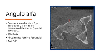 Medidas Radiologicas Cadera.pptx