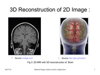 3D Reconstruction of 2D Image :

Source http://goo.gl/s3tq41
Source medigo.com
04/27/16 7Medical Image Analysis and Its Application
Fig 3: 2D MRI with 3D reconstruction of Brain
 