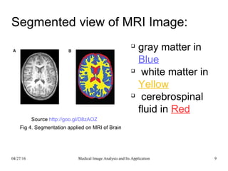 Segmented view of MRI Image:

gray matter in
Blue

white matter in
Yellow

cerebrospinal
fluid in Red
Source http://goo.gl/D8zAOZ
04/27/16 9Medical Image Analysis and Its Application
Fig 4. Segmentation applied on MRI of Brain
 