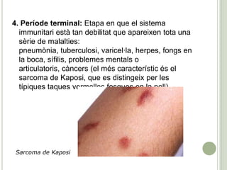 4. Període terminal: Etapa en que el sistema
immunitari està tan debilitat que apareixen tota una
sèrie de malalties:
pneumònia, tuberculosi, varicel·la, herpes, fongs en
la boca, sífilis, problemes mentals o
articulatoris, càncers (el més característic és el
sarcoma de Kaposi, que es distingeix per les
típiques taques vermelles fosques en la pell).
Sarcoma de Kaposi
 