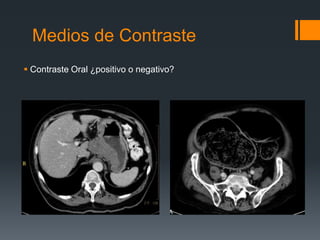 Medios de Contraste
 Contraste Oral ¿positivo o negativo?
 