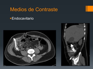 Medios de Contraste
Endocavitario
 