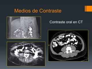 Medios de Contraste
Contraste oral en CT
 