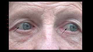 • Reacciones adversas al gadolineo:
• La mayoría de estas reacciones son leves y autolimitadas.
• Inmediatas: frio, calor, dolor en el sitio de punción.
• Tardías: FSN
 