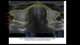 HIPERTIROIDISMO
• Suele presentarse tardíamente.
• Enf de graves o hipertiroideos.
• Administrar fármaco antitiroideo antes del estudio.
• Si se administra contraste radioactivo hay que esperar 2
meses para hacer un centellograma tiroideo.
 