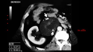 TU. PRODUCTOR DE
CATECOLAMINAS
• Feocromocitomas y paragangliomas.
• Producen HTA de difícil tratamiento.
• Los medio de contraste producen exacerbación de los
síntomas.
• Una semana antes del estudio comenzar con tratamiento alfa
o beta bloqueante.
 