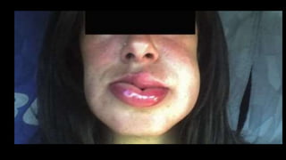 • REACCION ANAFILACTOIDEA SEVERA:
• O2
• S.F
• Difenhidramina ev
• Betaagonistas.
• Adrenalina.
• Hidrocortisona.
 