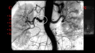 OTRAS VIAS DE ADMINISTRACION
• Intraarteriales: estudios angiograficos con contrastes
yodados.
• Gadolinio con CO2 en pacientes alérgicos con insuficiencia
renal.
• Intraarticulares: contraste yodado o gadolinio.
• Intracanaliculares: Sialografía o cistografía.
 