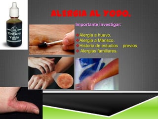 ALERGIA AL YODO.
Importante Investigar:
Alergia a huevo.
Alergia a Marisco.
Historia de estudios previos
 Alergias familiares.
 