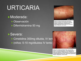 URTICARIA
Moderada:
 Observación
 Difenhidramina 50 mg
Severa:
 Cimetidina 300mg diluida, IV lenta.
 (niños: 5-10 mg/diluidos IV lento)
 