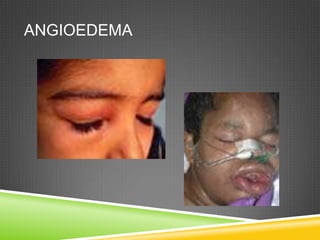 ANGIOEDEMA
 