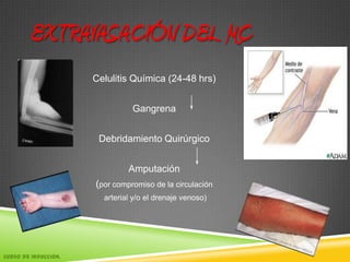 EXTRAVASACIÓN DEL MC
Celulitis Química (24-48 hrs)
Gangrena
Debridamiento Quirúrgico
Amputación
(por compromiso de la circulación
arterial y/o el drenaje venoso)
Curso de Inducción.
 