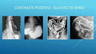 CONTRASTE POSITIVO: SULFATO DE BARIO
 