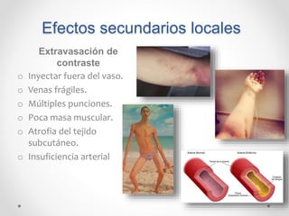 Efectos secundarios locales
Extravasación de
contraste
o Inyectar fuera del vaso.
o Venas frágiles.
o Múltiples punciones.
o Poca masa muscular.
o Atrofia del tejido
subcutáneo.
o Insuficiencia arterial
 