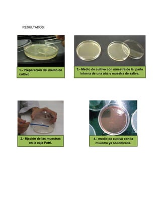 RESULTADOS:
3.- Medio de cultivo con muestra de la parte
interna de una uña y muestra de saliva.
1.- Preparación del medio de
cultivo
2.- fijación de las muestras
en la caja Petri.
4.- medio de cultivo con la
muestra ya solidificada.
 