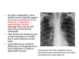 • On plain radiographs, nerve
sheath tumors typically appear
as sharply marginated round,
elliptical, or lobulated
paravertebral masses,
although they may be well
seen only on the frontal
radiograph
• They tend to be limited to one
or two interspaces in length
but in some patients can be
large.
• Associated rib or vertebral
deformity or enlargement of a
neural foramen is visible in
about 50% of cases Schwannoma. PA chest radiograph shows a
well-defined right mediastinal mass associated
with deformity of right-sided ribs.
 
