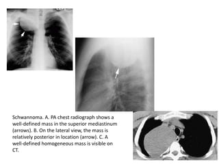 Schwannoma. A. PA chest radiograph shows a
well-defined mass in the superior mediastinum
(arrows). B. On the lateral view, the mass is
relatively posterior in location (arrow). C. A
well-defined homogeneous mass is visible on
CT.
 