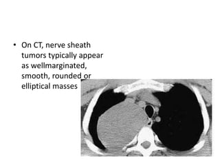 • On CT, nerve sheath
tumors typically appear
as wellmarginated,
smooth, rounded or
elliptical masses
 