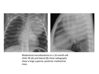 Mediastinal neuroblastoma in a 16-month-old
child. PA (A) and lateral (B) chest radiographs
show a large superior, posterior mediastinal
mass
 