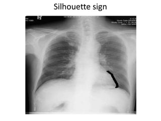 Silhouette sign
 