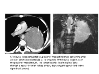 CT shows a large paravertebral, posterior mediastinal mass containing small
areas of calcification (arrows). D. T2-weighted MRI shows a large mass in
the posterior mediastinum. The tumor extends into the spinal canal
through a neural foramen (white arrow), displacing the spinal cord to the
right (black arrow).
 