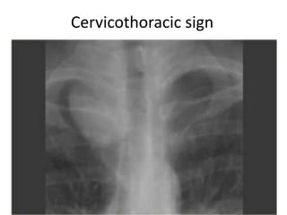 Cervicothoracic sign
 