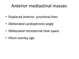 Anterior mediastinal masses
• Displaced anterior junctional lines
• Obliterated cardiophrenic angle
• Obliterated retrosternal clear space
• Hilum overlay sign
 
