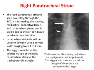 Right Paratracheal Stripe
• The right paratracheal stripe is
seen projecting through the
SVC. It is formed by the trachea,
mediastinal connective tissue,
and paratracheal pleura and is
visible due to the air–soft tissue
interfaces on either side.
• paratracheal stripe should be
uniform in width with a normal
width ranging from 1 to 4 mm.
• The azygos vein lies at the
inferior margin of the right
paratracheal stripe at the
tracheobronchial angle.
Posteroanterior chest radiograph shows
the right paratracheal stripe (arrow).
The azygos vein is seen at the inferior
margin of the stripe at the
tracheobronchial angle.
 