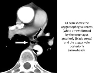 CT scan shows the
azygoesophageal recess
(white arrow) formed
by the esophagus
anteriorly (black arrow)
and the azygos vein
posteriorly
(arrowhead).
 