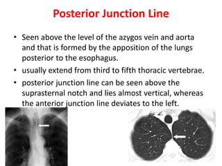 Posterior Junction Line
• Seen above the level of the azygos vein and aorta
and that is formed by the apposition of the lungs
posterior to the esophagus.
• usually extend from third to fifth thoracic vertebrae.
• posterior junction line can be seen above the
suprasternal notch and lies almost vertical, whereas
the anterior junction line deviates to the left.
 