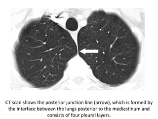 CT scan shows the posterior junction line (arrow), which is formed by
the interface between the lungs posterior to the mediastinum and
consists of four pleural layers.
 