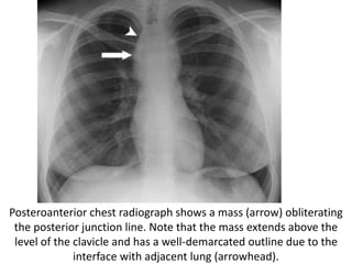 Posteroanterior chest radiograph shows a mass (arrow) obliterating
the posterior junction line. Note that the mass extends above the
level of the clavicle and has a well-demarcated outline due to the
interface with adjacent lung (arrowhead).
 