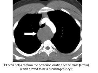 CT scan helps confirm the posterior location of the mass (arrow),
which proved to be a bronchogenic cyst.
 
