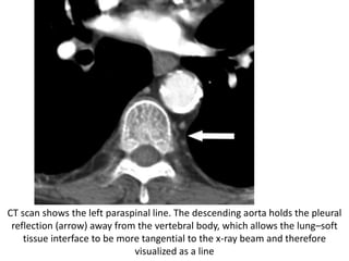 CT scan shows the left paraspinal line. The descending aorta holds the pleural
reflection (arrow) away from the vertebral body, which allows the lung–soft
tissue interface to be more tangential to the x-ray beam and therefore
visualized as a line
 
