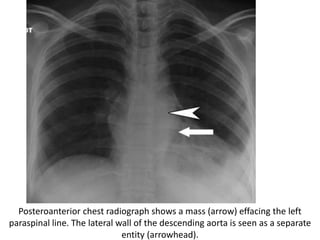 Posteroanterior chest radiograph shows a mass (arrow) effacing the left
paraspinal line. The lateral wall of the descending aorta is seen as a separate
entity (arrowhead).
 