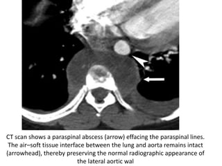 CT scan shows a paraspinal abscess (arrow) effacing the paraspinal lines.
The air–soft tissue interface between the lung and aorta remains intact
(arrowhead), thereby preserving the normal radiographic appearance of
the lateral aortic wal
 