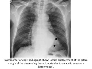 Posteroanterior chest radiograph shows lateral displacement of the lateral
margin of the descending thoracic aorta due to an aortic aneurysm
(arrowheads).
 