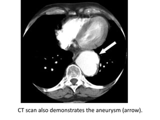 CT scan also demonstrates the aneurysm (arrow).
 