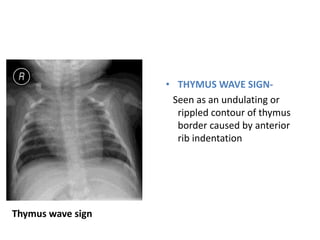 Thymus wave sign
• THYMUS WAVE SIGN-
Seen as an undulating or
rippled contour of thymus
border caused by anterior
rib indentation
 