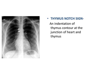 • THYMUS NOTCH SIGN-
An indentation of
thymus contour at the
junction of heart and
thymus
 