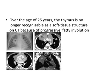 • Over the age of 25 years, the thymus is no
longer recognizable as a soft-tissue structure
on CT because of progressive fatty involution
 