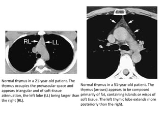 Normal thymus in a 21-year-old patient. The
thymus occupies the prevascular space and
appears triangular and of soft-tissue
attenuation, the left lobe (LL) being larger than
the right (RL).
Normal thymus in a 51-year-old patient. The
thymus (arrows) appears to be composed
primarily of fat, containing islands or wisps of
soft tissue. The left thymic lobe extends more
posteriorly than the right.
 