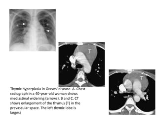 Thymic hyperplasia in Graves' disease. A. Chest
radiograph in a 40-year-old woman shows
mediastinal widening (arrows). B and C. CT
shows enlargement of the thymus (T) in the
prevascular space. The left thymic lobe is
largest
 