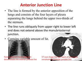 Anterior Junction Line
• The line is formed by the anterior apposition of the
lungs and consists of the four layers of pleura
separating the lungs behind the upper two-thirds of
the sternum.
• The line runs obliquely from upper right to lower left
and does not extend above the manubriosternal
junction.
• Contains variable amount of fat.
Posteroanterior chest radiograph
demonstrates the anterior junction line
CT scan shows the four layers of pleura that
constitute the anterior junction line
 